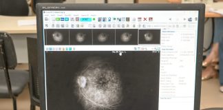 Glaucoma evolui sem sintomas e já é a principal causa de cegueira irreversível no mundo Glaucoma